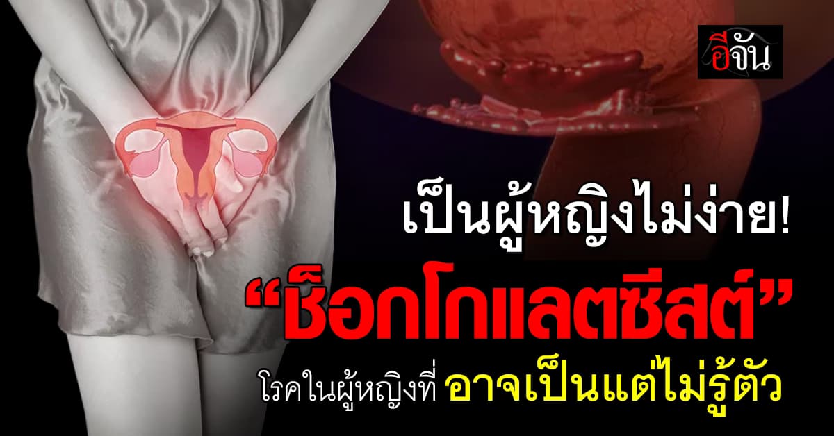 เช็กอาการ “ช็อกโกแลตซีสต์” โรคผู้หญิงที่อาจเป็นแต่ไม่รู้ตัว 