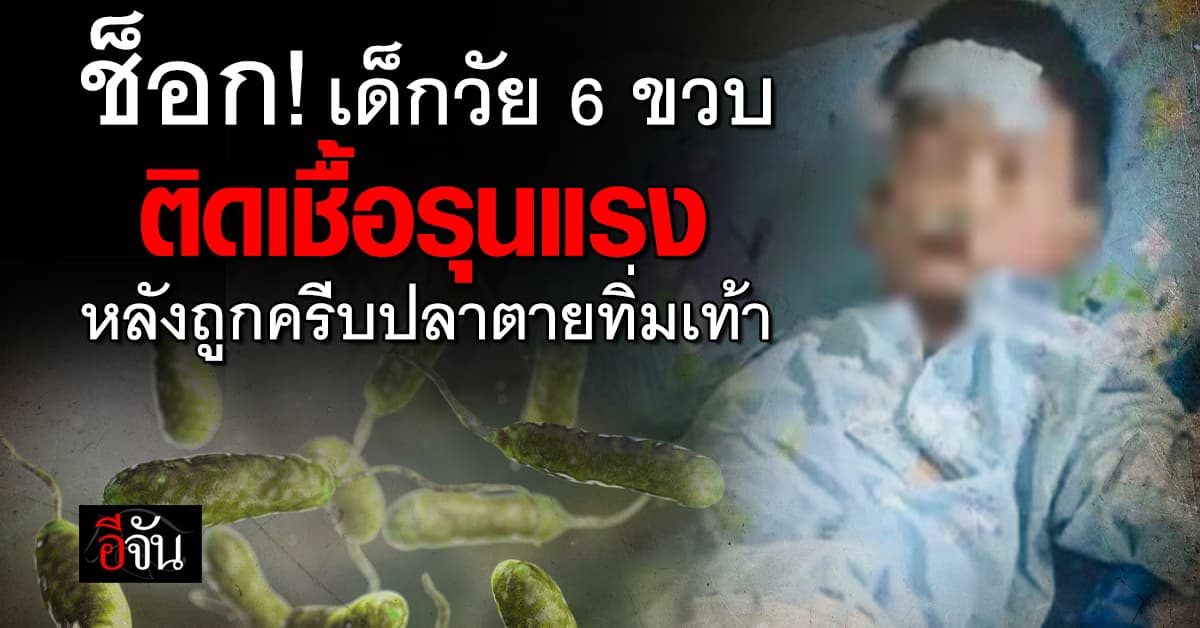 เด็กจีน ลงเล่นน้ำทะเลเหยียบปลาตายครีบทิ่มเท้า ติดเชื้อรุนแรง 