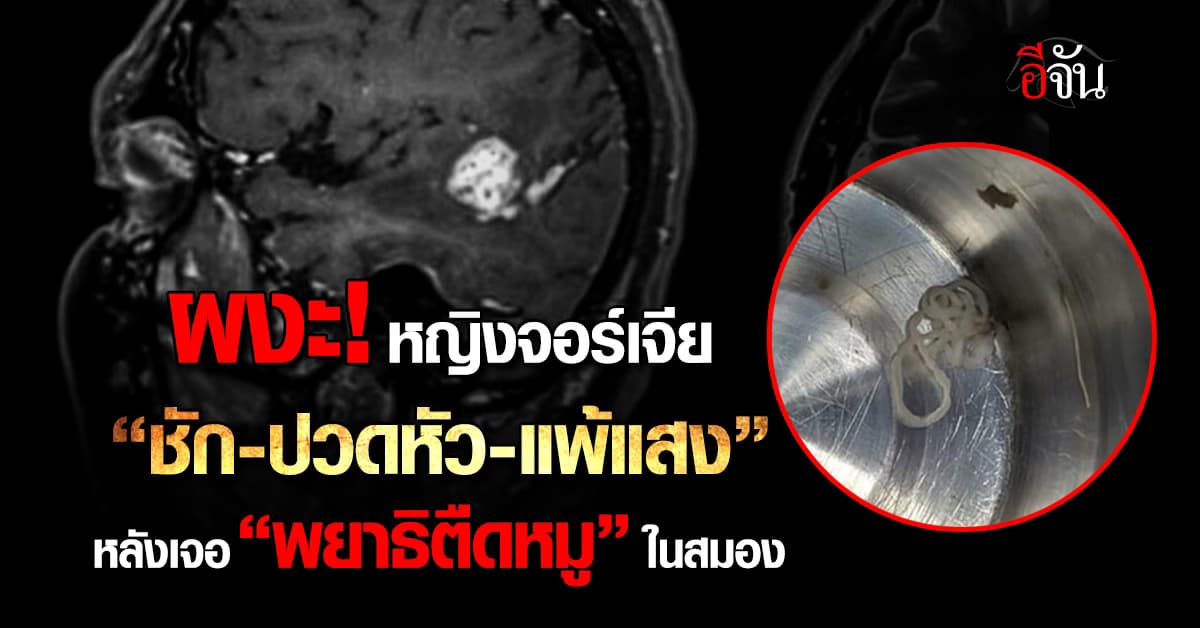 หญิง มีอาการ “ชัก-ปวดหัว-แพ้แสง” เจอ “พยาธิตืดหมู” ในสมอง 