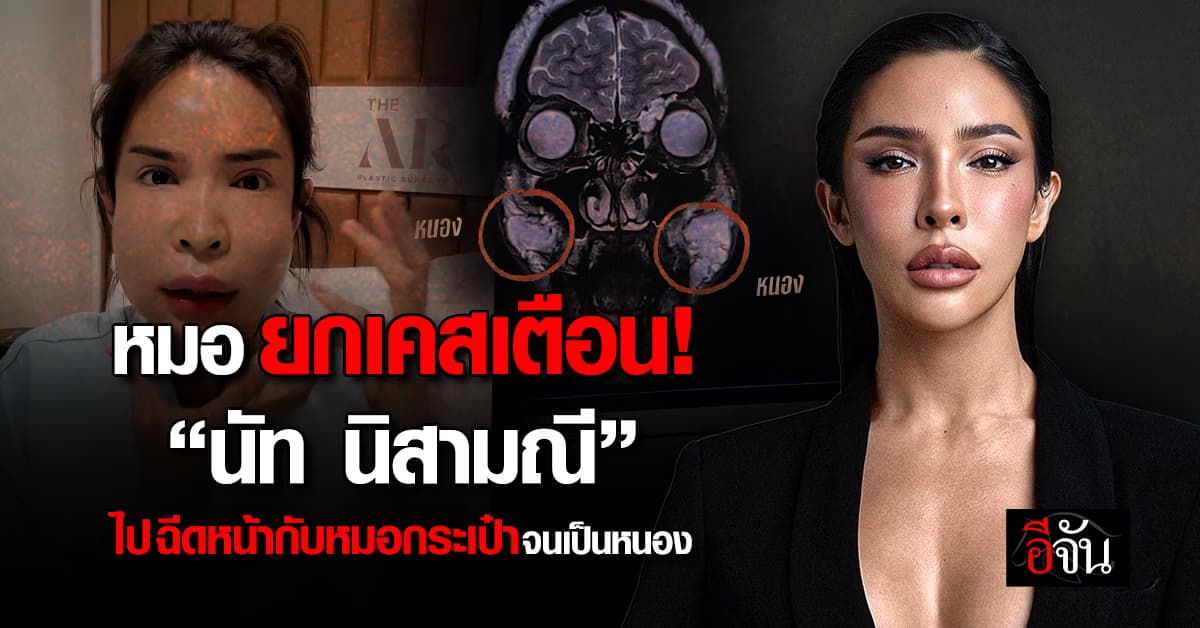หมอ เตือน! เคส “นัท นิสามณี” ฉีดหน้ากับหมอกระเป๋าจนเป็นหนองที่แก้ม 
