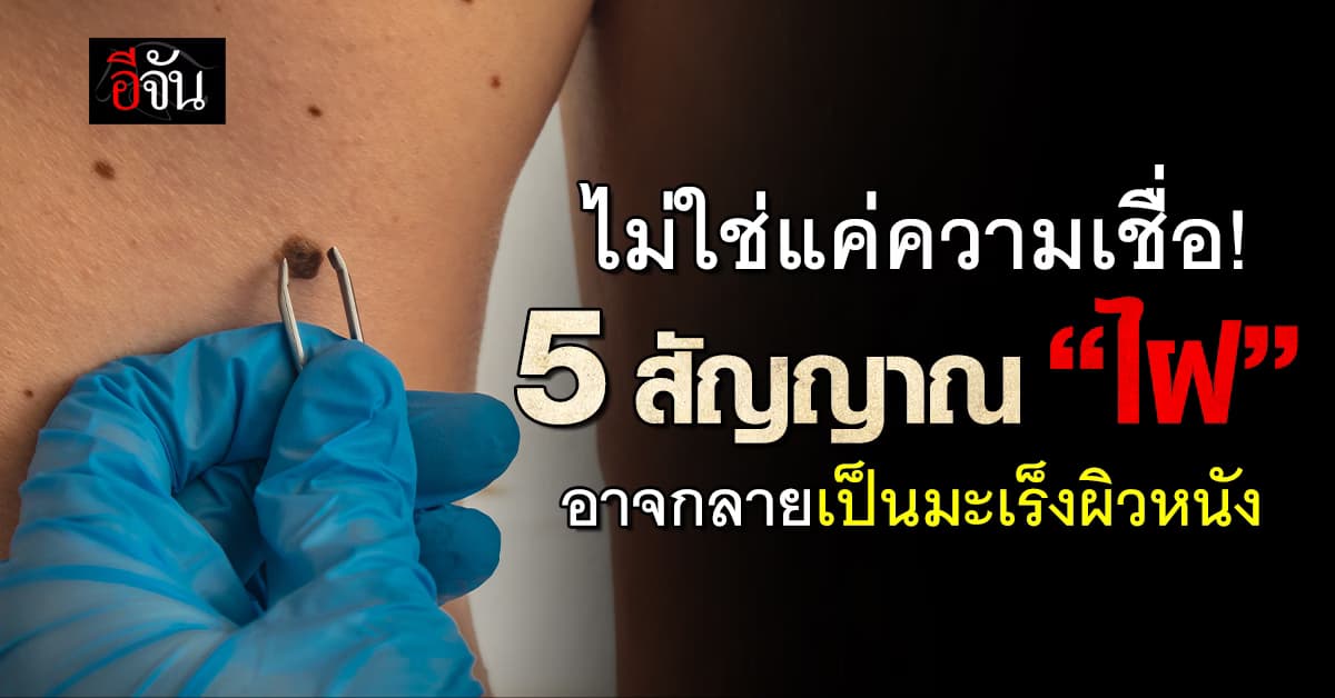 รู้ช้าอันตราย! สัญญาณ “ไฝ” 5 ข้อ อาจบอกว่าเป็นมะเร็ง