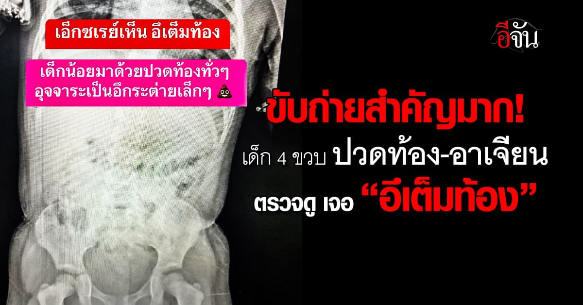 อุทาหรณ์! เด็ก 4 ขวบ ปวดท้อง-อาเจียน เอ็กซเรย์เจอ อึเต็มท้อง