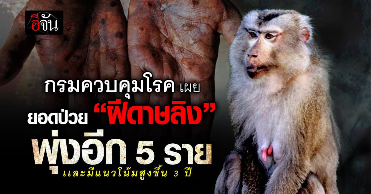 กรมควบคุมโรค เผยยอดป่วย โรคฝีดาษลิง ในไทยที่ติดเพิ่มเเล้ว 5 ราย