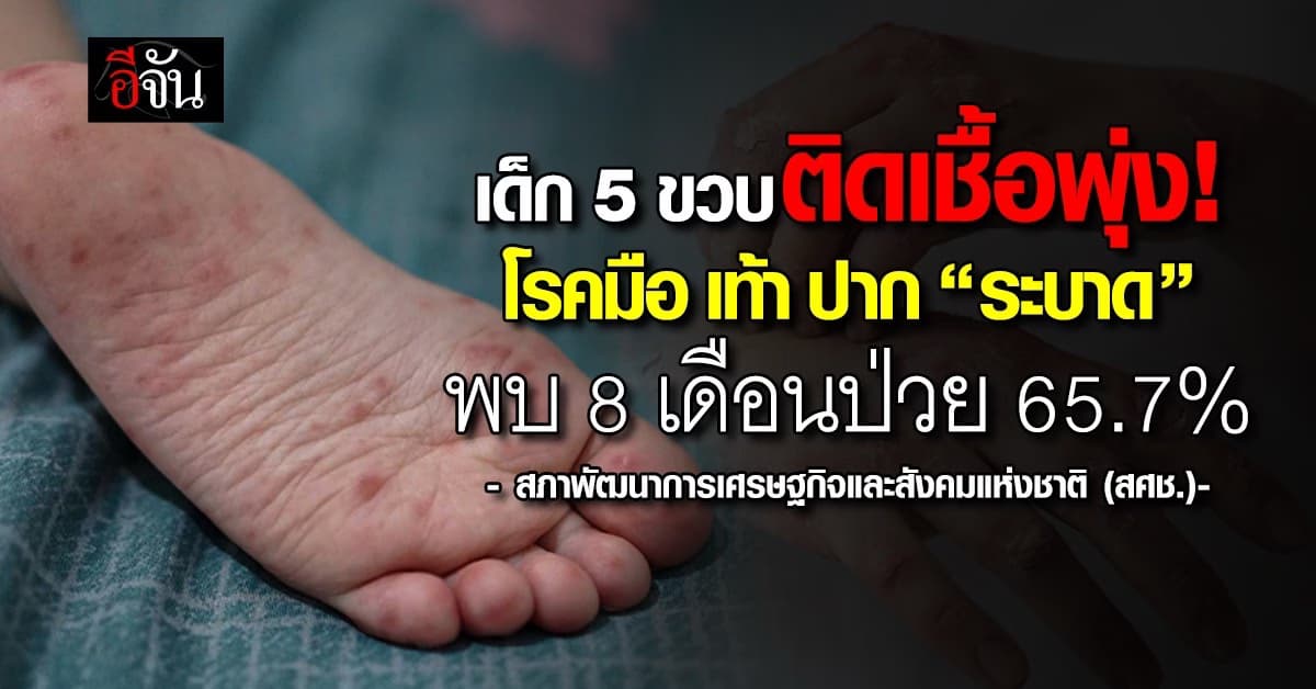 เด็ก 5 ขวบติดเชื้อพุ่ง! โรคมือ เท้า ปาก “ระบาด” พบ 8 เดือนป่วย 65.7%