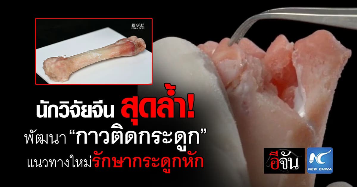 ไอเดียใสเเจ๋ว! “กาวติดกระดูก” แนวทางใหม่รักษากระดูกหัก