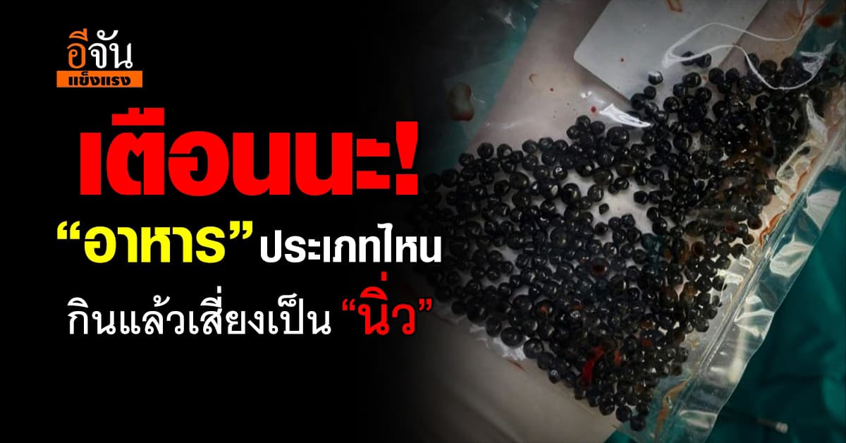 เช็กด่วน! อาหารอะไรบ้าง? ที่กินแล้วเสี่ยงเป็น “นิ่ว” 