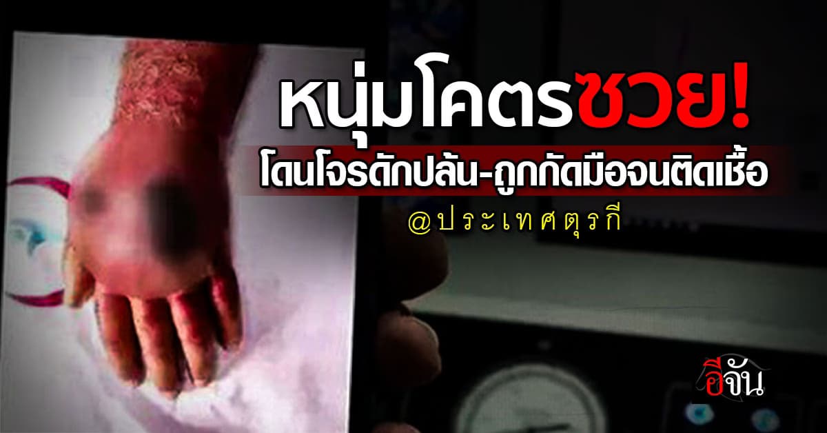 หนุ่มใหญ่ถึงคราวซวย โดนโจรดักปล้น-กัดมือสู้เพื่อหลบหนี จนเกือบเสียแขน 