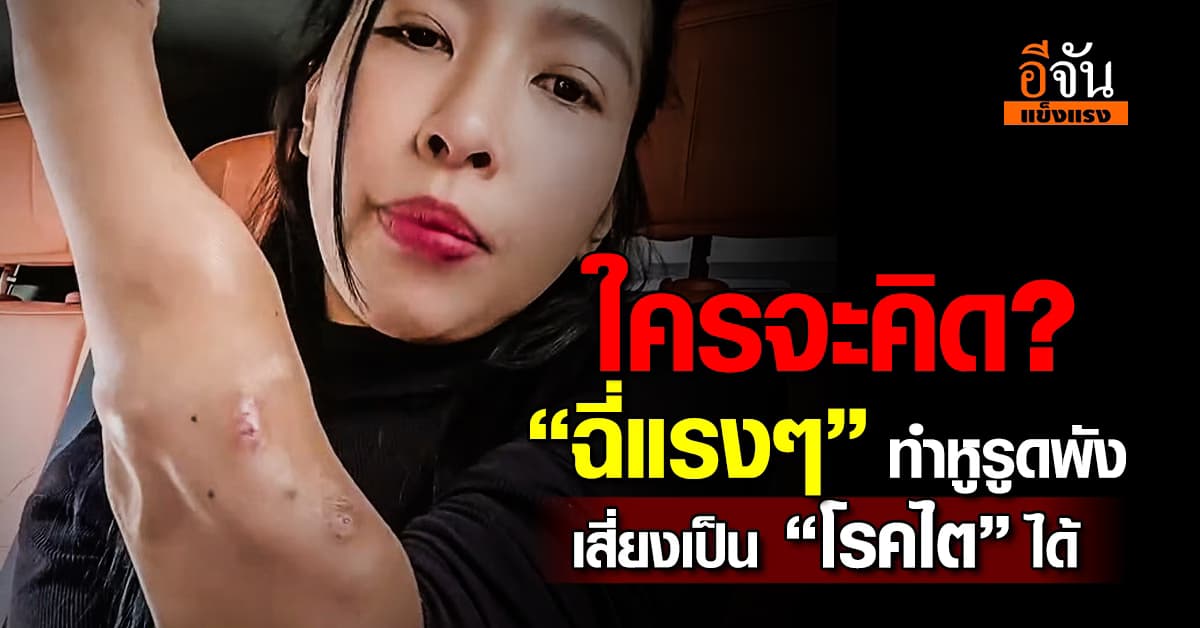 สาวป่วย “โรคไตระยะสุดท้าย” เปิดเบื้องหลังเคยเบ่งฉี่ เพราะฉี่ไม่ออก  