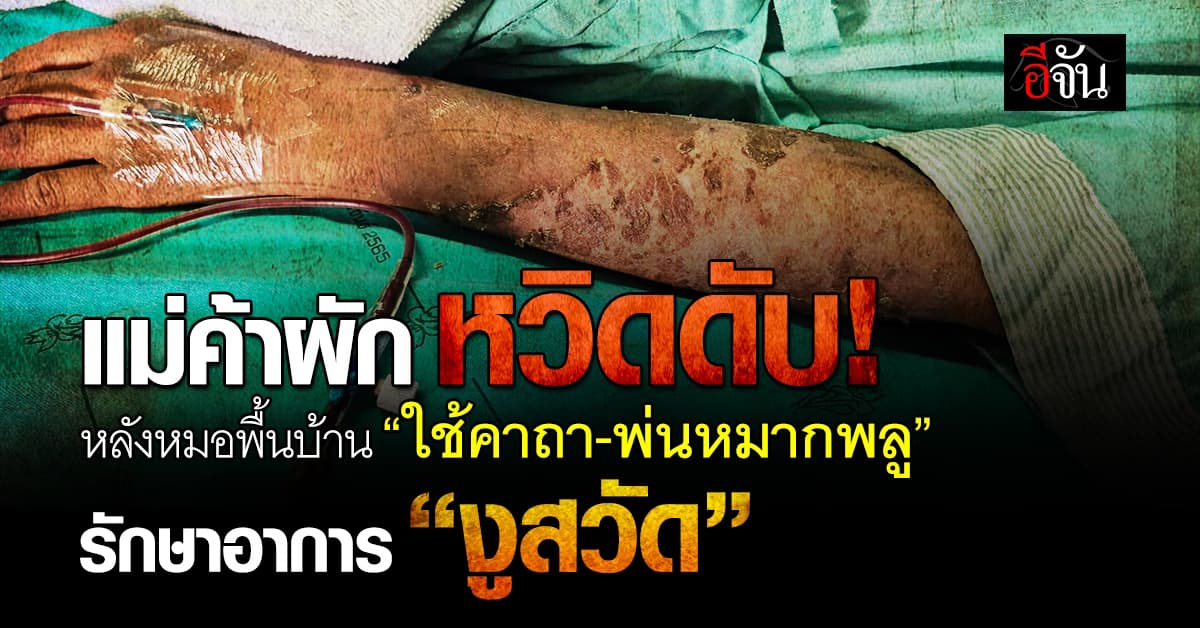 แม่ค้าผักหวิดดับ หลังหมอพื้นบ้านท่องคาถาพ่นหมากพลูใส่เพื่อรักษา “งูสวัด” 