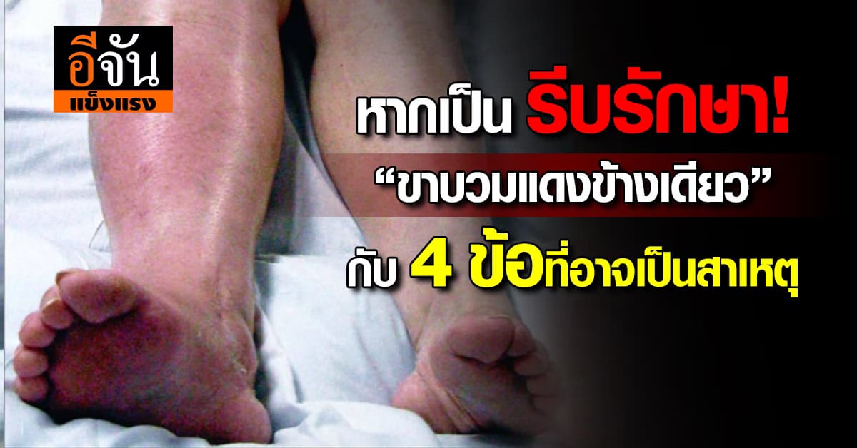 ถ้าปล่อยไว้อาจเสียขา! “ขาบวมแดงข้างเดียว” อาจเสี่ยงโรคร้าย 