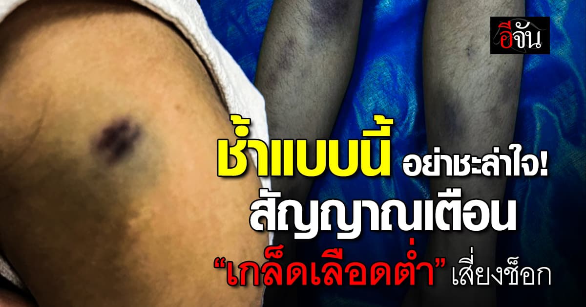 ช้ำทั่วตัวโดยไม่มีสาเหตุ อย่าชะล่าใจ! สัญญาณเตือน “เกล็ดเลือดต่ำ” เสี่ยงช็อก 