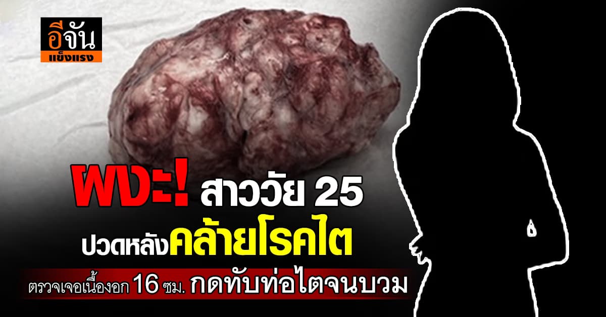 สาววัย 25 ปี ปวดหลังคล้ายโรคไต ตรวจเจอเนื้องอกกดทับท่อไตจนบวม
