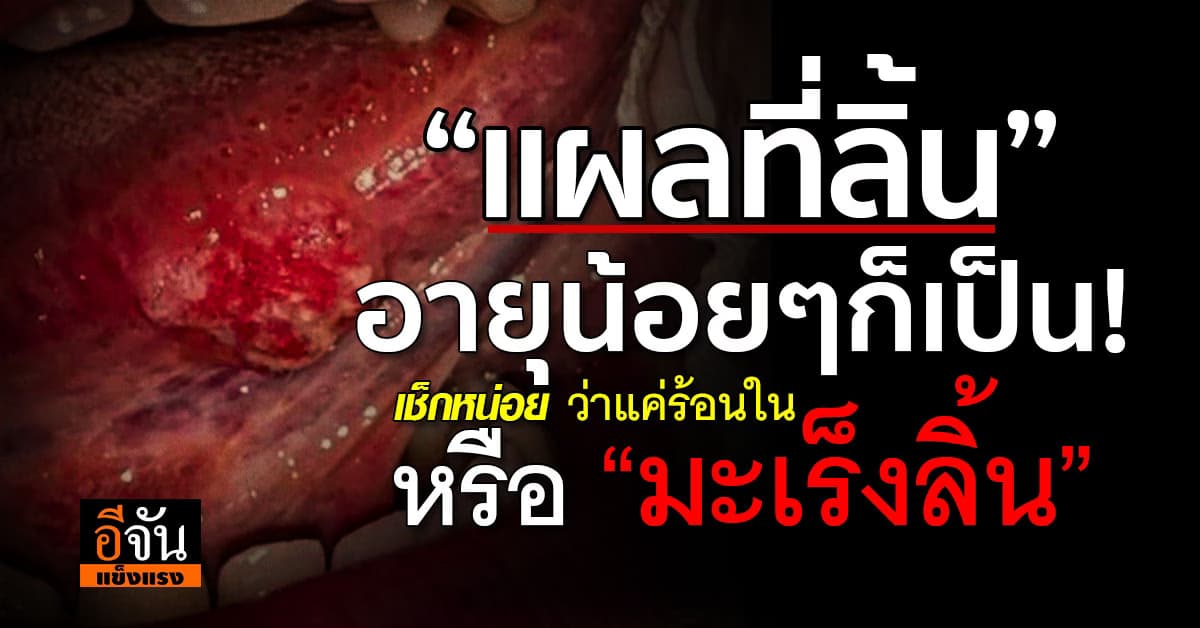 ชะล่าใจไม่ได้นะ! “แผลที่ลิ้น” เป็นเพราะร้อนใน หรือ “มะเร็งลิ้น”? 