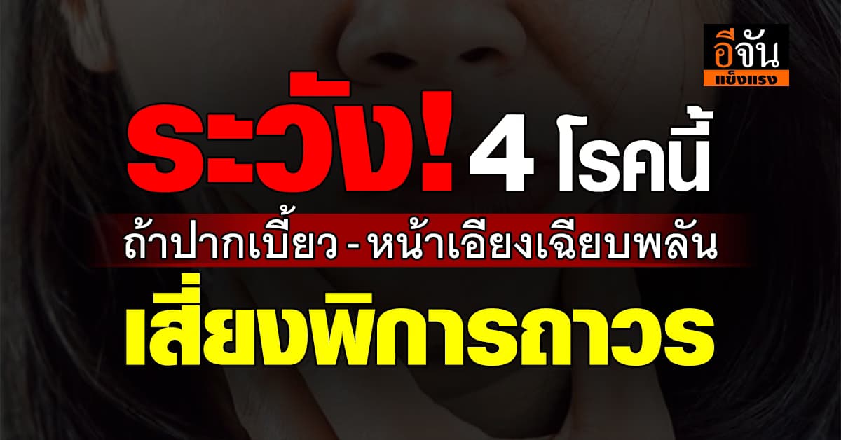 หมอเจด เตือน! ปากเบี้ยว-หน้าเบี้ยว ระวังเป็น 4 โรคร้าย