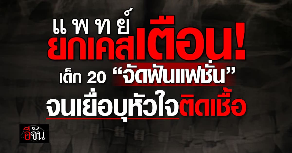 แพทย์ ยกเคสเตือน! เด็ก 20 ปี “จัดฟันแฟชั่น” จนเยื่อบุหัวใจติดเชื้อ