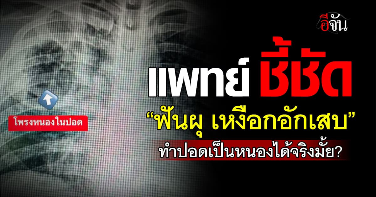 แพทย์ ชี้ชัด “ฟันผุ เหงือกอักเสบ” ทำปอดเป็นหนองได้จริงมั้ย?