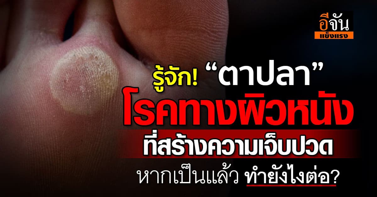 “ตาปลา” โรคทางผิวหนังที่สร้างความเจ็บปวด พร้อมวิธีการรักษา