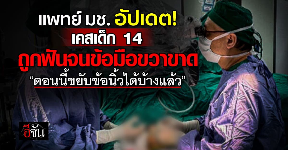 ข่าวดี! แพทย์ มช. อัปเดตเคสเด็ก 14 ถูกฟันข้อมือขวาขาด