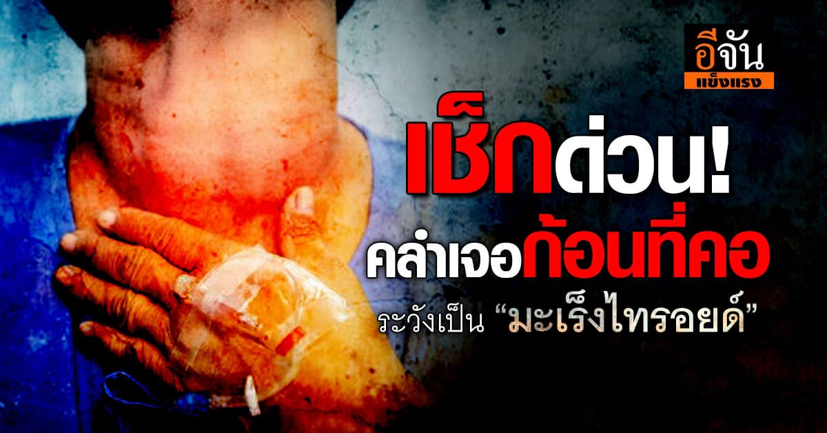 5 สัญญาณต่อมไทรอยด์ หากคลำเจอก้อนที่คอ ระวังเป็น “มะเร็งไทรอยด์”