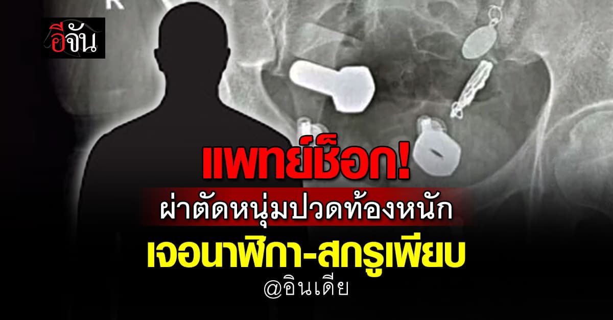 หนุ่มอินเดียปวดท้องหนัก แพทย์ X-Ray เจอนาฬิกา-สกรูเพียบ