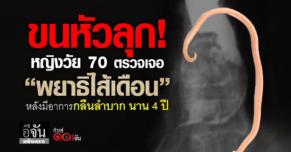 อุทาหรณ์! หญิงวัย 70 มีอาการกลืนลำบาก ตรวจเจอพยาธิไส้เดือนในหลอดอาหาร 
