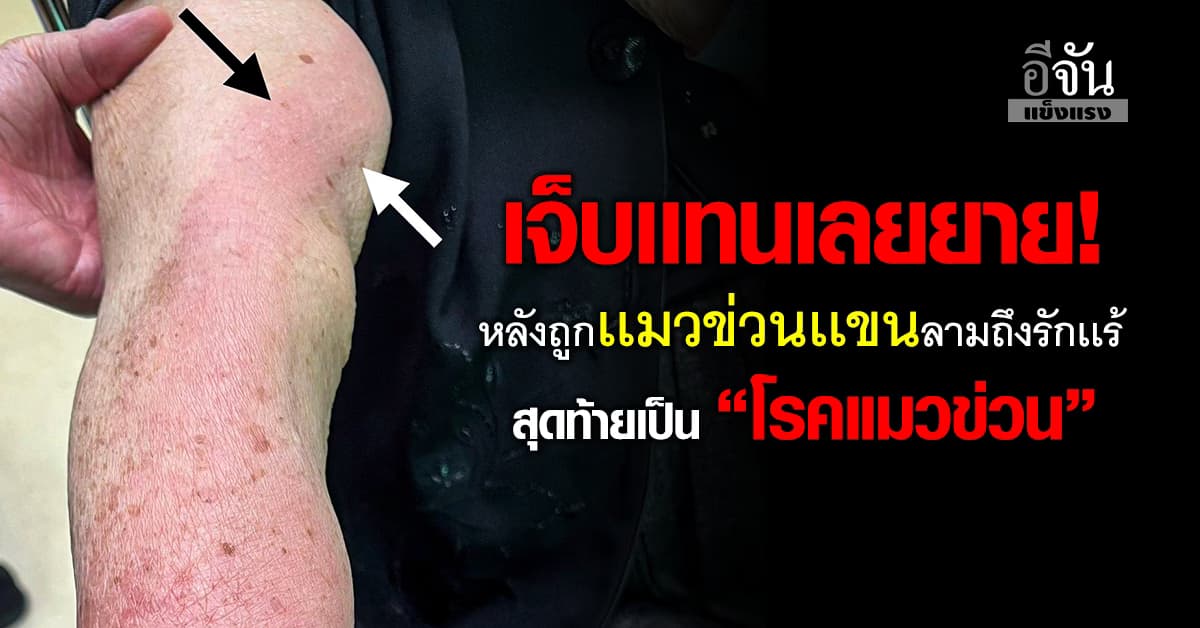 เตือนภัย! หญิงวัย 82 ถูกแมวที่เลี้ยงข่วนที่แขน สุดท้ายเป็น “โรคแมวข่วน”