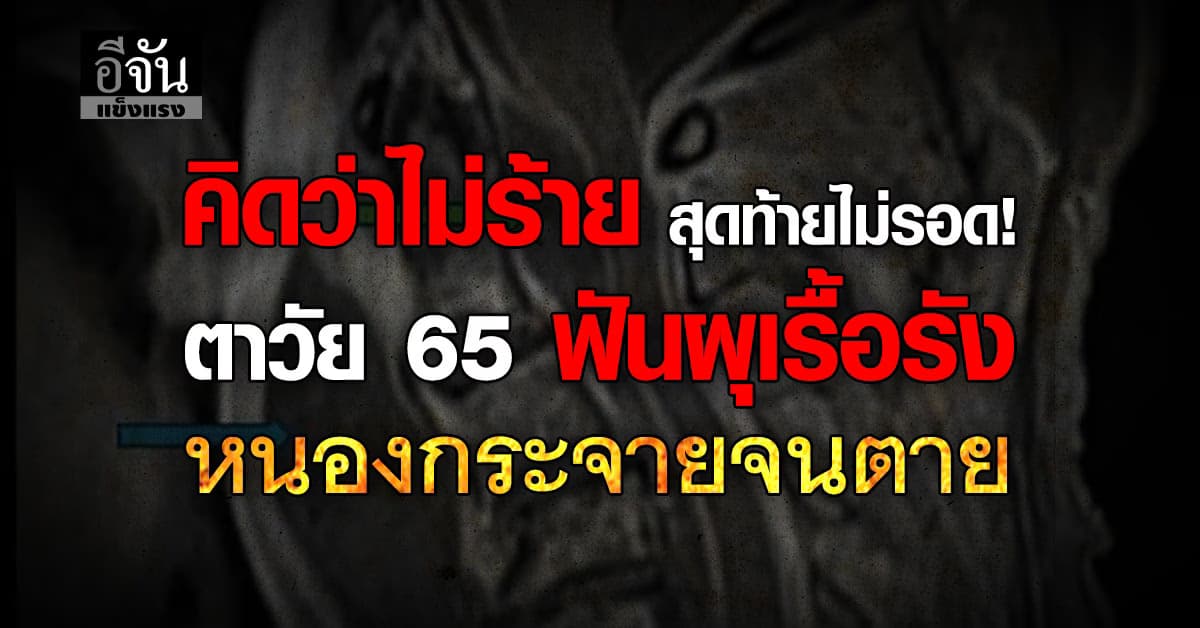 คิดว่าไม่ร้าย สุดท้ายไม่รอด! ตาวัย 65 ปี ฟันผุเรื้อรัง หนองกระจายจนเสียชีวิต