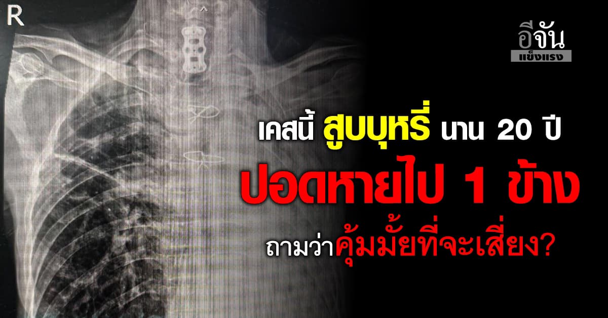 เคสนี้เตือนภัย! สูบบุหรี่นาน 20 ปี ทำปอดหายไป 1 ข้าง