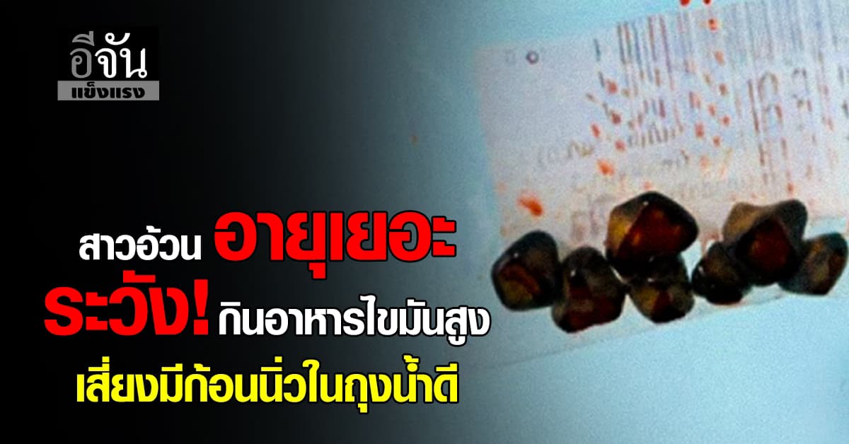 ถ้าไม่ระวังอาจเสี่ยง! สาวอ้วน อายุเยอะ ที่กินอาหารไขมันสูง เสี่ยงนิ่วในถุงน้ำดี 