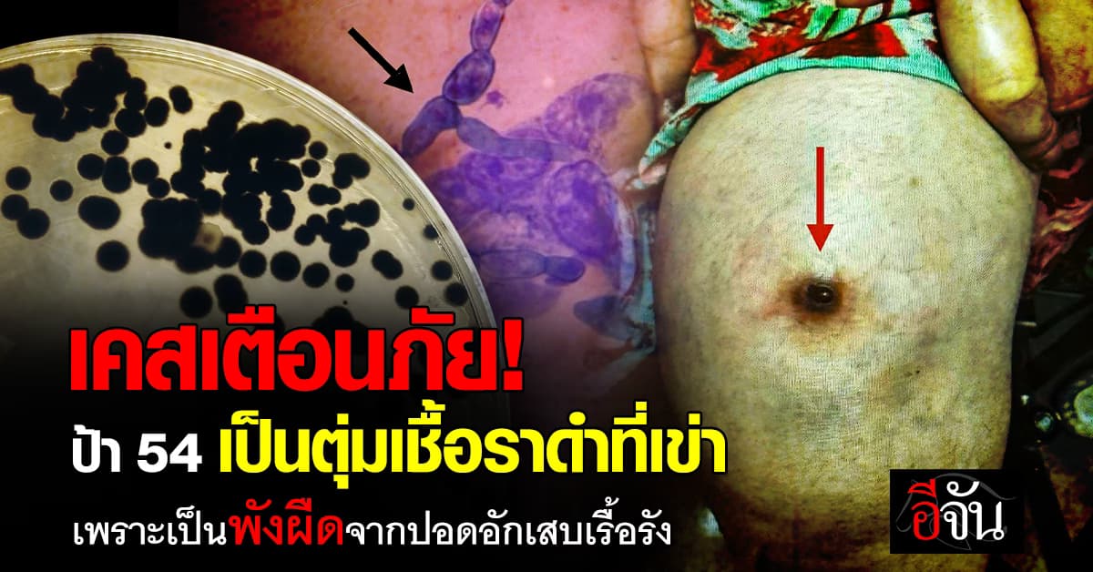 หญิงวัย 54 ปี เกิดตุ่มเชื้อราดำที่เข่า เพราะโรคปอดอักเสบเรื้อรัง