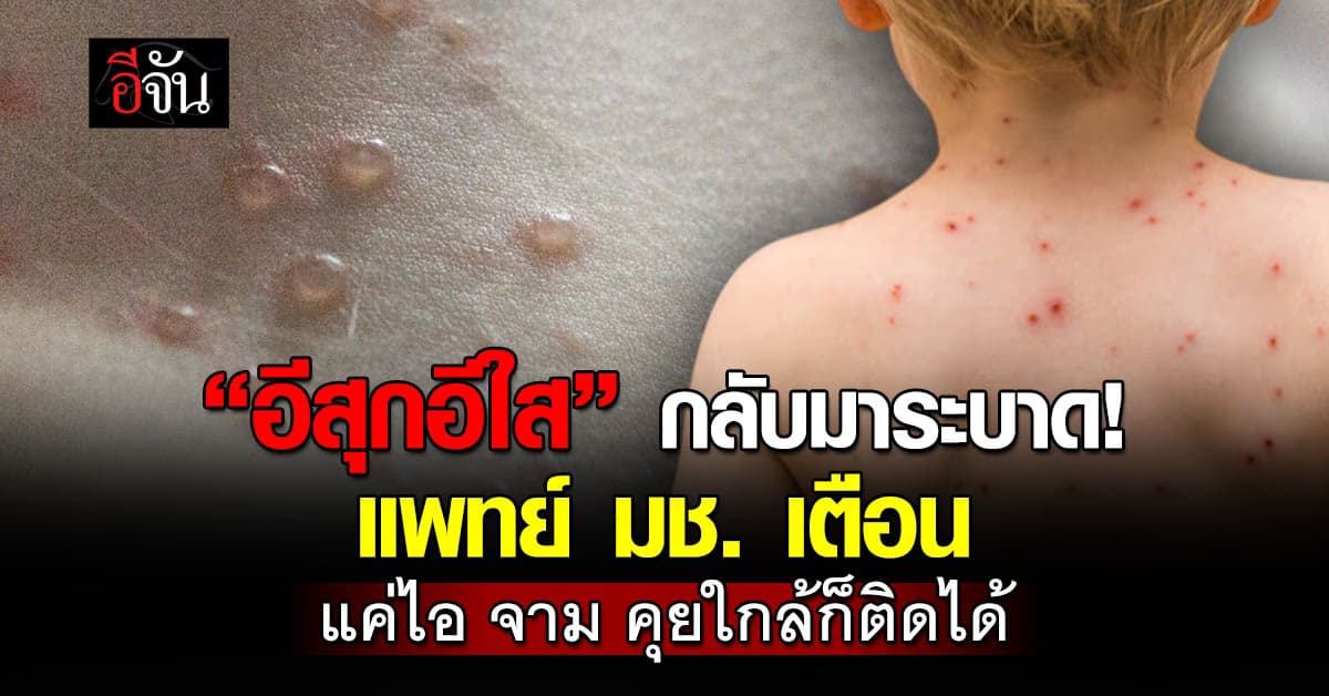 “อีสุกอีใส” กลับมาระบาด! แพทย์ มช. เตือน แค่ไอ จาม คุยใกล้ก็ติดได้ 
