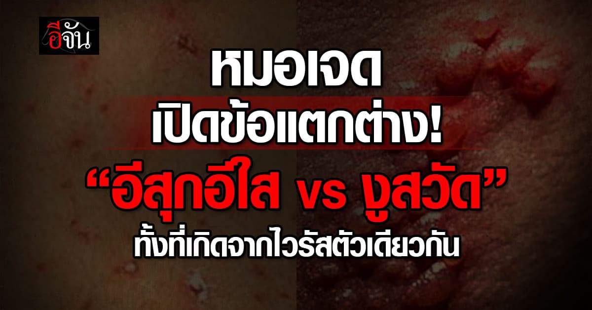 หมอเจด เปิดข้อแตกต่าง! “อีสุกอีใส VS งูสวัด” ทั้งที่เกิดจากไวรัสตัวเดียวกัน 