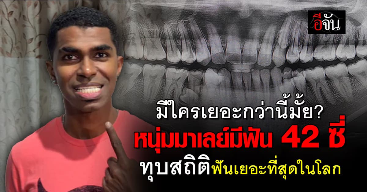 ทุบสถิติกินเนสส์บุ๊ก! หนุ่มฟันเยอะที่สุดในโลก นับได้ 42 ซี่ 