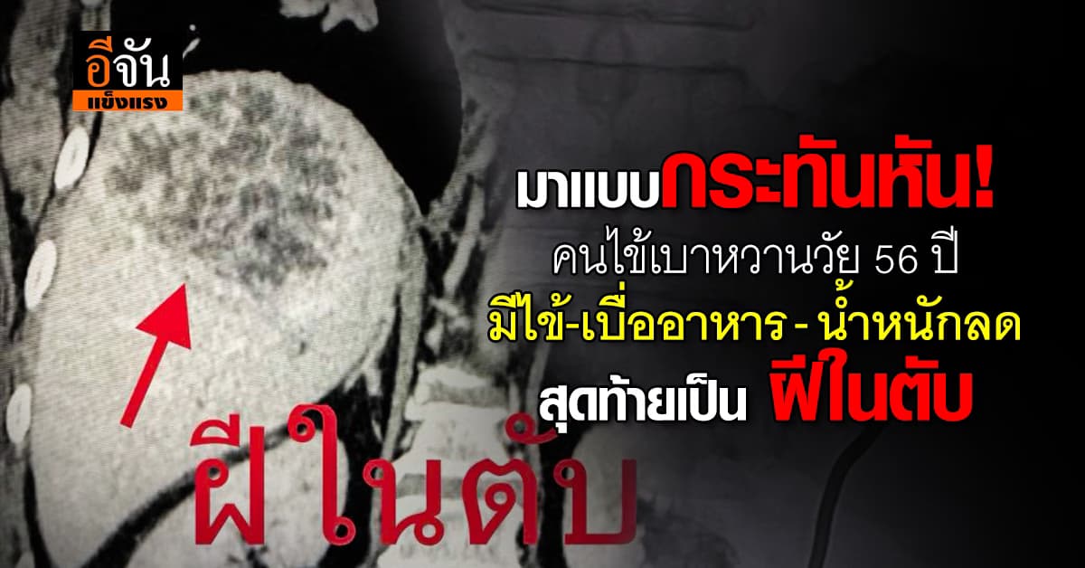 ช็อก! หมอ ยกเคสคนไข้เบาหวาน มีไข้-เบื่ออาหาร- น้ำหนักลด สุดท้ายเป็น ฝีในตับ 