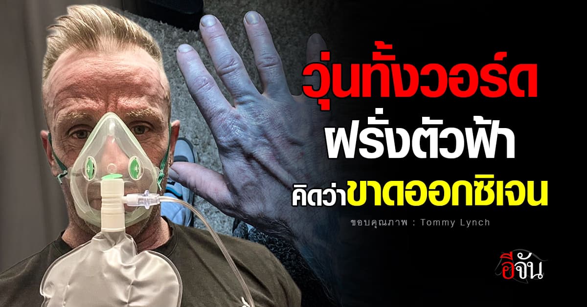 ฝรั่งช็อก ตื่นมาตัวฟ้า! รีบไปรพ. คิดว่าป่วย สุดท้ายคดีพลิก