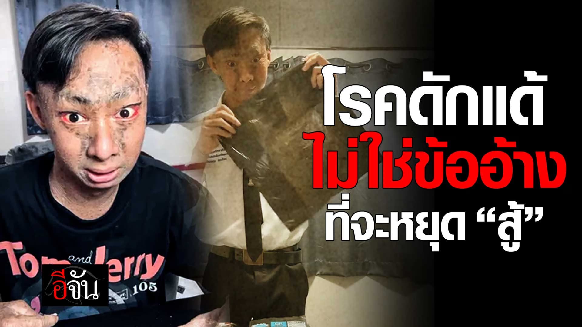 🎬 โรคดักแด้ ไม่ใช่ข้ออ้าง ที่จะหยุด “สู้”