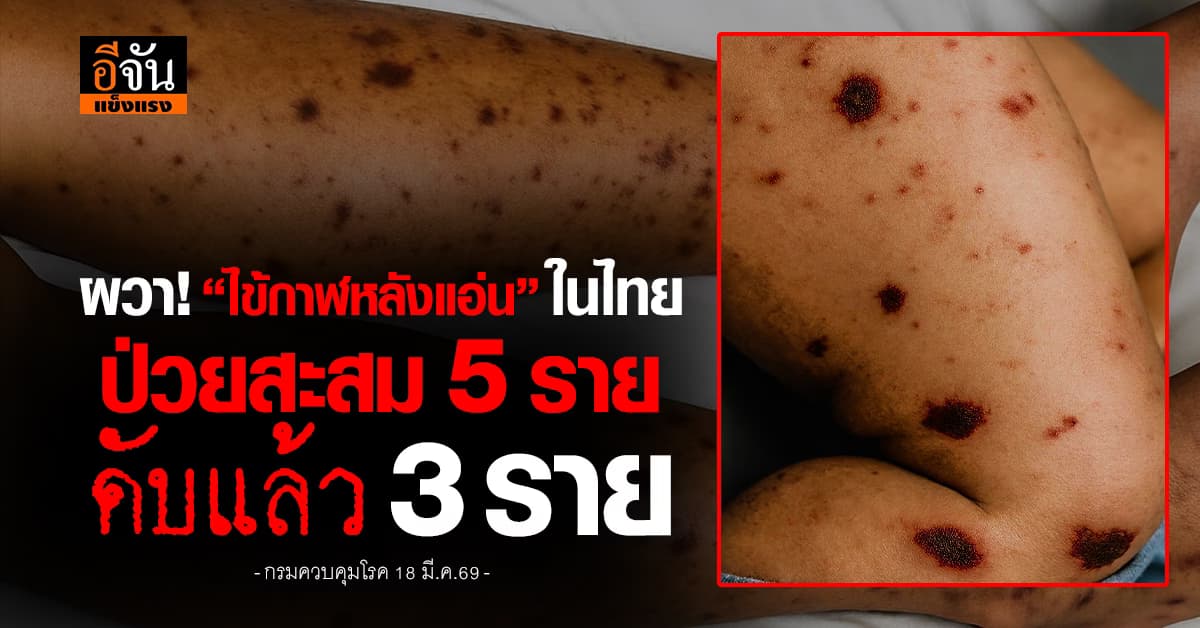 เช็กอาการให้ดี! “โรคไข้กาฬหลังแอ่น” ในไทยป่วยสะสม 5 ราย ดับเเล้ว 3 ราย 