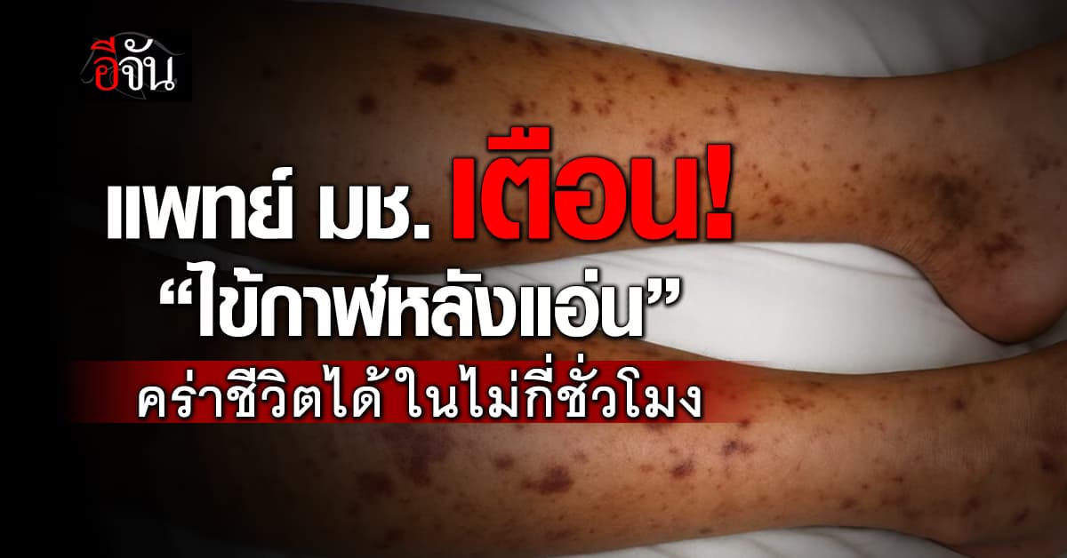 แพทย์ มช. เตือน! “ไข้กาฬหลังแอ่น” คร่าชีวิตได้ในไม่กี่ชั่วโมง 