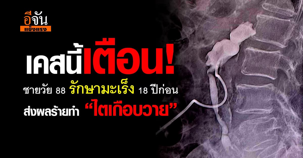 ชายวัย 88 ไตเกือบวาย เพราะผลจากการรักษามะเร็งเมื่อ 18 ปีที่แล้ว 