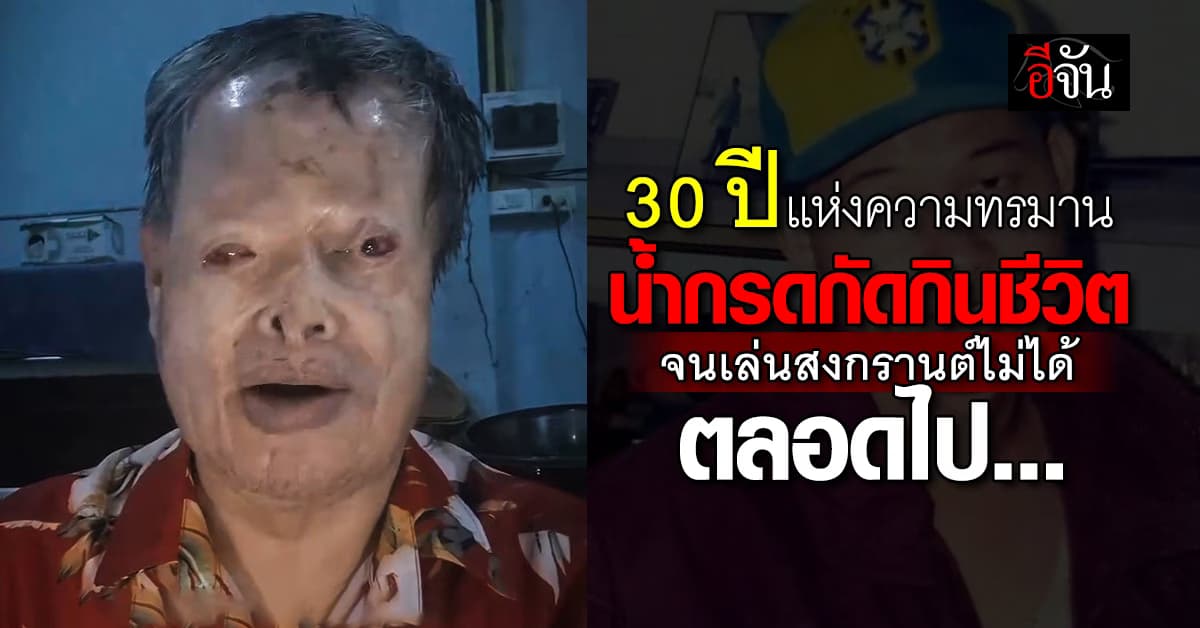 30 ปีแห่งความทรมานของเหยื่อน้ำกรด “ลุงธรรศ” ชายผู้เล่นน้ำสงกรานต์ไม่ได้ ตลอดชีวิต!