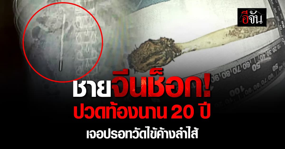 ชายจีนปวดท้องนาน 20 ปี สุดท้ายแพทย์เจอ “ปรอทวัดไข้” ค้างลำไส้