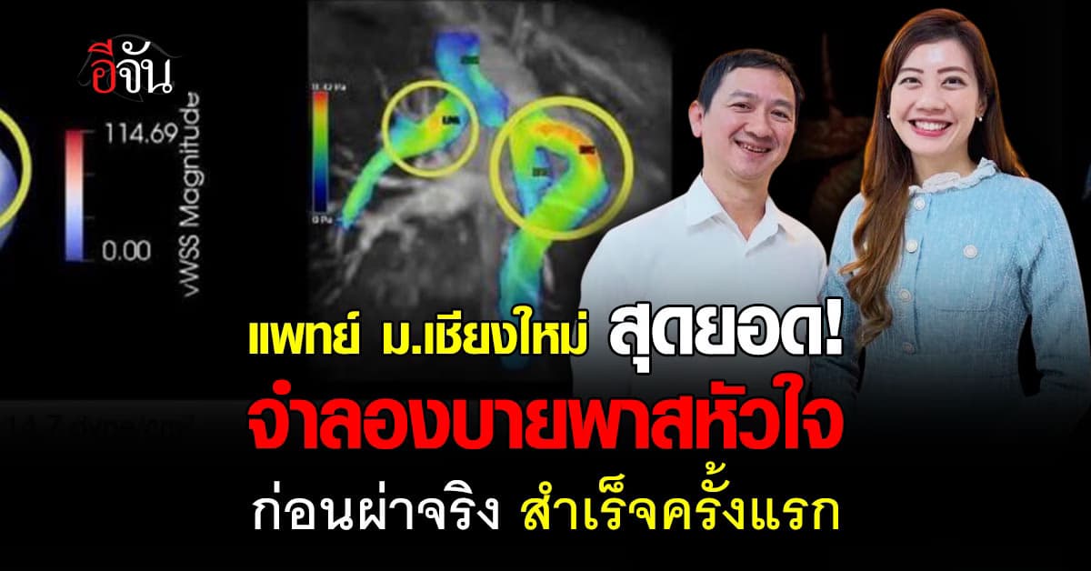 แพทย์ ม.เชียงใหม่ ใช้แบบจำลองบายพาสหัวใจ ก่อนผ่าสำเร็จครั้งแรกในไทย  