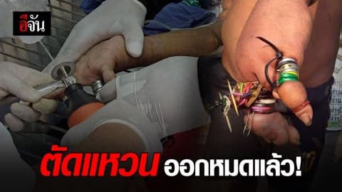 รอดแล้ว! จนท. ช่วยเหลือชายเร่ร่อน หลังแหวนติดนิ้วจนบวมเป่ง