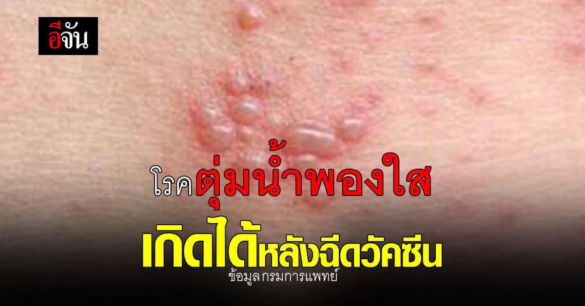 อธิบดีกรมการแพทย์ ชี้ โรคตุ่มน้ำพองใส อาจเกิดขึ้นได้หลังฉีดวัคซีนโควิด