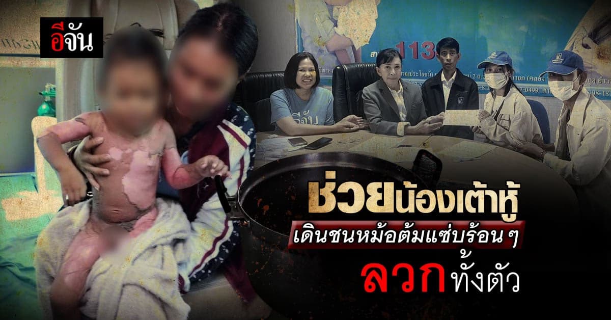 เด็กน้อย 2 ขวบ น้องเต้าหู้ เดินชนหม้อต้มแซ่บร้อนๆ ลวกทั้งตัว