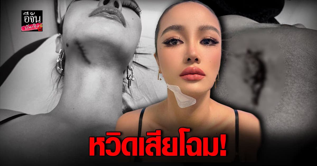 แห่เป็นห่วง กระแต อาร์สยาม หวิดเสียโฉม คางแตก เย็บ 5 เข็ม!