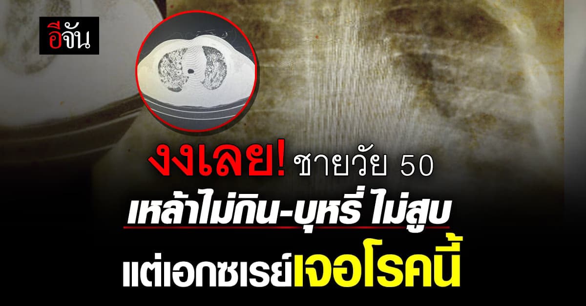 เหนื่อยง่าย รีบตรวจ! ชายวัย 50 เหล้าไม่กินบุหรี่ไม่สูบ แต่เป็นโรคนี้