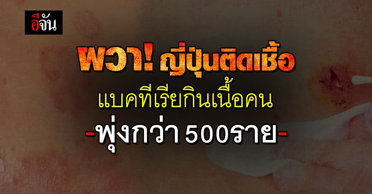 ผวาทั้งโลก! “ญี่ปุ่น” พบผู้ติดเชื้อ “แบคทีเรียสเตรปโตคอคคัส” แบคทีเรียกินเนื้อคน พุ่งกว่า 500 ราย