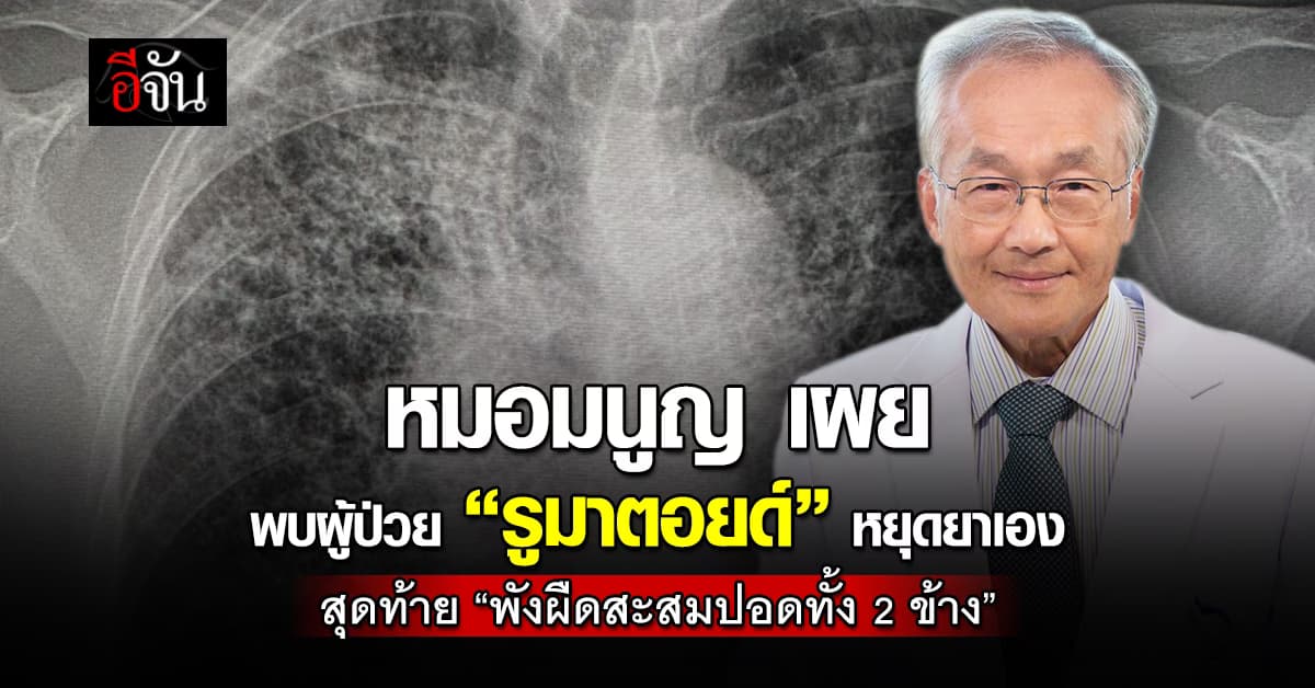 หมอมนูญ เผยเคสหญิงป่วย “โรครูมาตอยด์” นาน 4 ปี ก่อนหยุดยาเอง สุดท้าย “พังผืดสะสมปอดทั้ง 2 ข้าง”