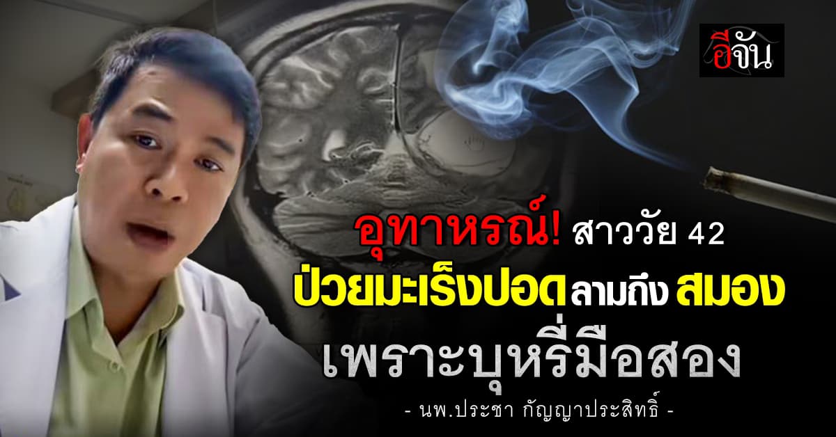 อุทาหรณ์! หมอสมอง ยกเคสเตือน สาว 42 ปี ป่วยมะเร็งปอดลามถึงสมอง เพราะบุหรี่มือสอง